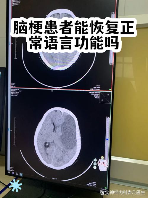 脑梗能不能恢复正常吗
