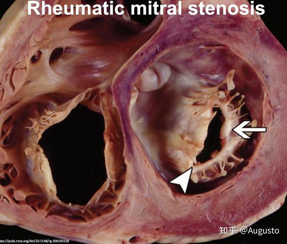 风湿性心脏病形成血栓
