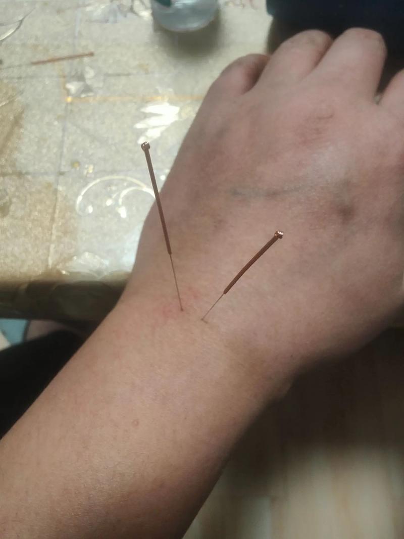 中暑扎针灸什么穴位