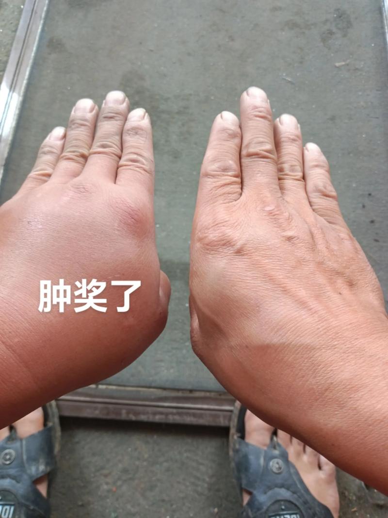 蜜蜂蛰能治风湿关节炎