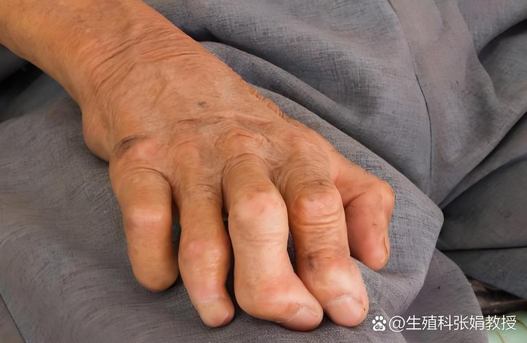 类风湿关节炎晚期卧床