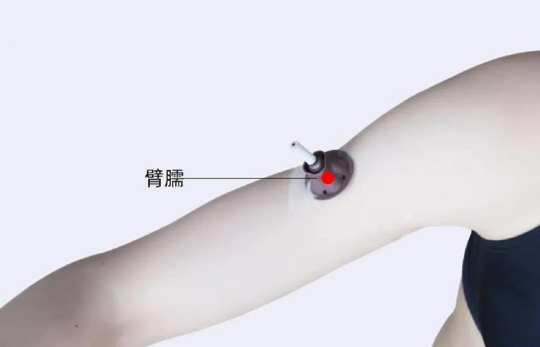 手臂痛针灸什么穴位