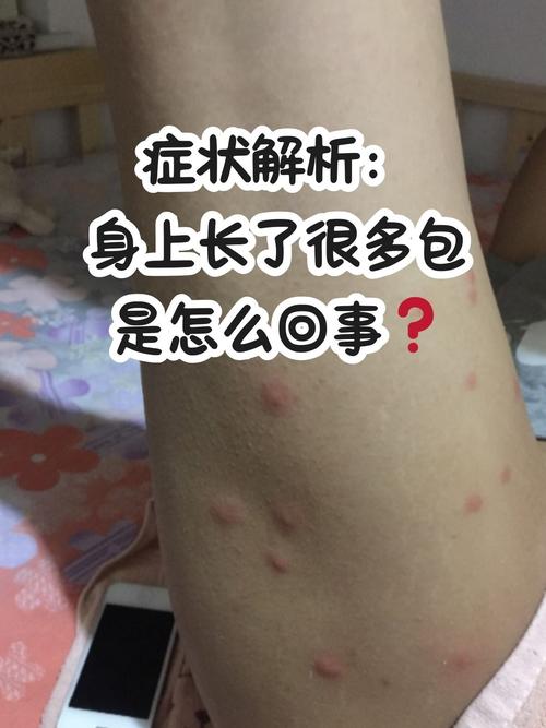 风湿病皮肤起红疙瘩吗