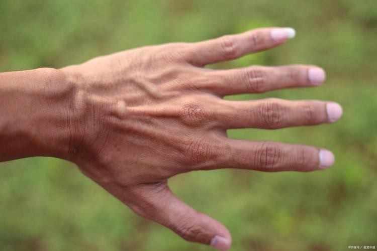 类风湿关节炎手部畸形