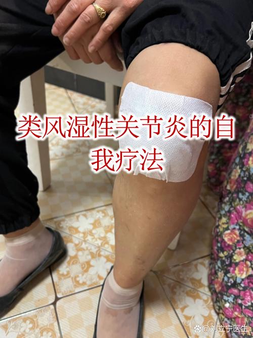 尚杰治疗类风湿有效率