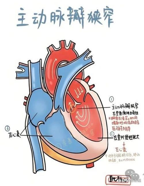 风湿性心脏瓣膜病原因
