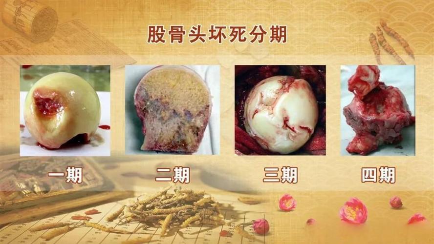 类风湿引起股骨头坏死