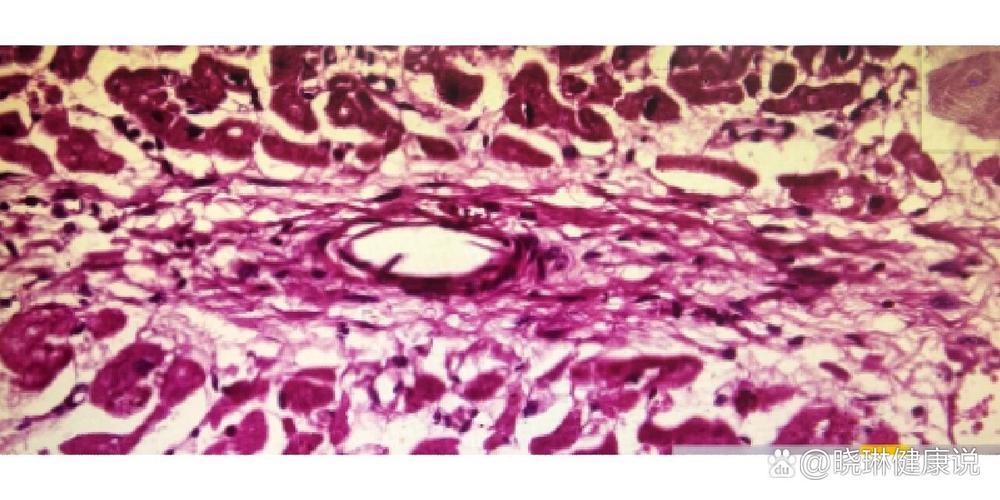 风湿性心肌炎病理图片