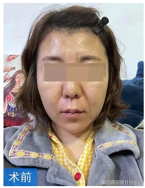 脑梗强哭强笑能恢复吗