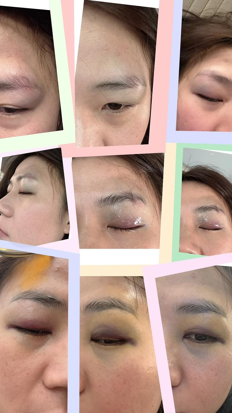 脑梗眼睛看不见 恢复