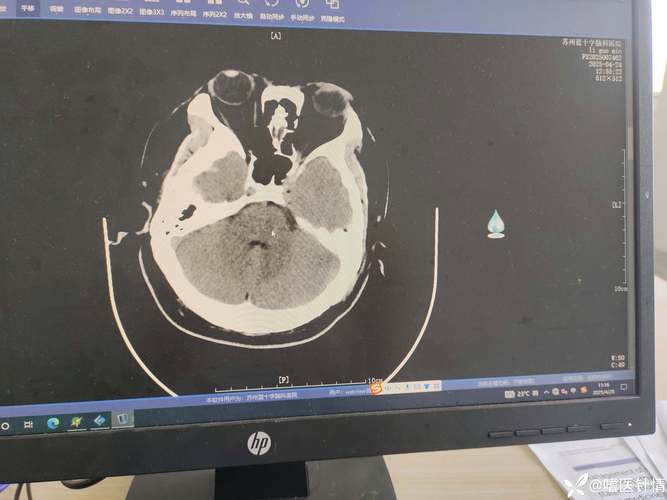郑州第一附属医院脑梗