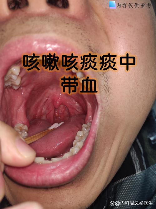 风湿性心脏病咳血治疗
