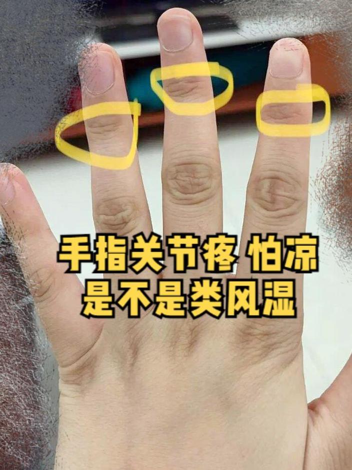 类风湿关节炎手部表现