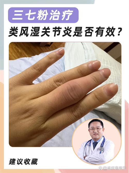 风湿免疫病是怎么得的