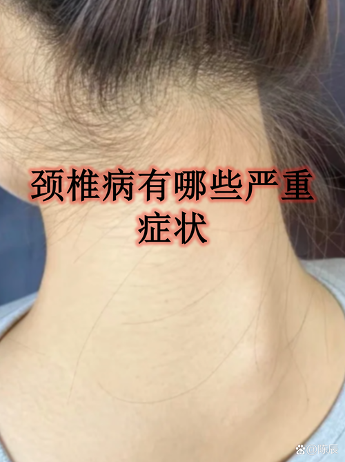 颈椎病和风湿有关系吗