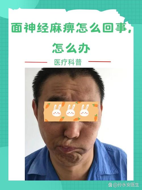 脑梗引起的面瘫能好吗