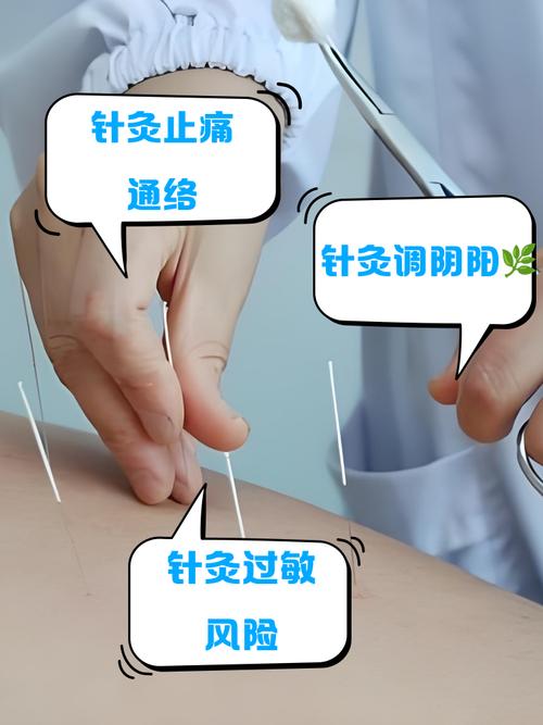 类风湿关节炎可以扎针