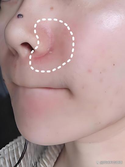 右侧脑梗 鼻唇沟变浅