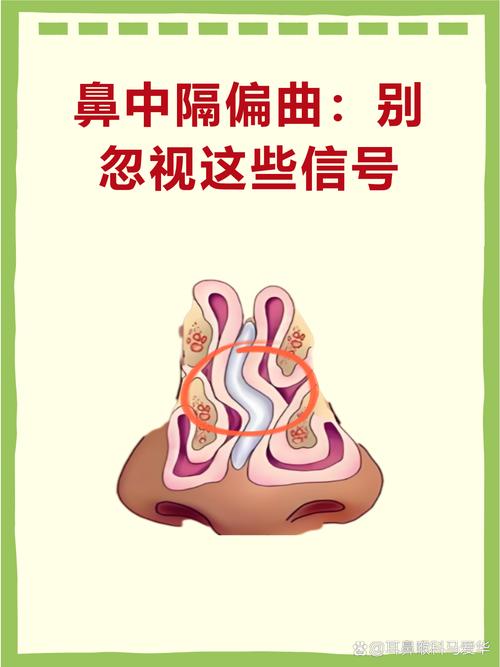 右侧脑梗 鼻唇沟变浅