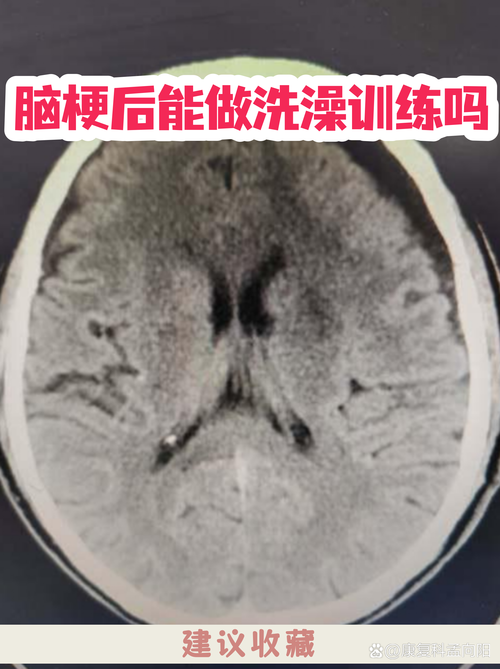 脑梗病人出院能洗澡吗