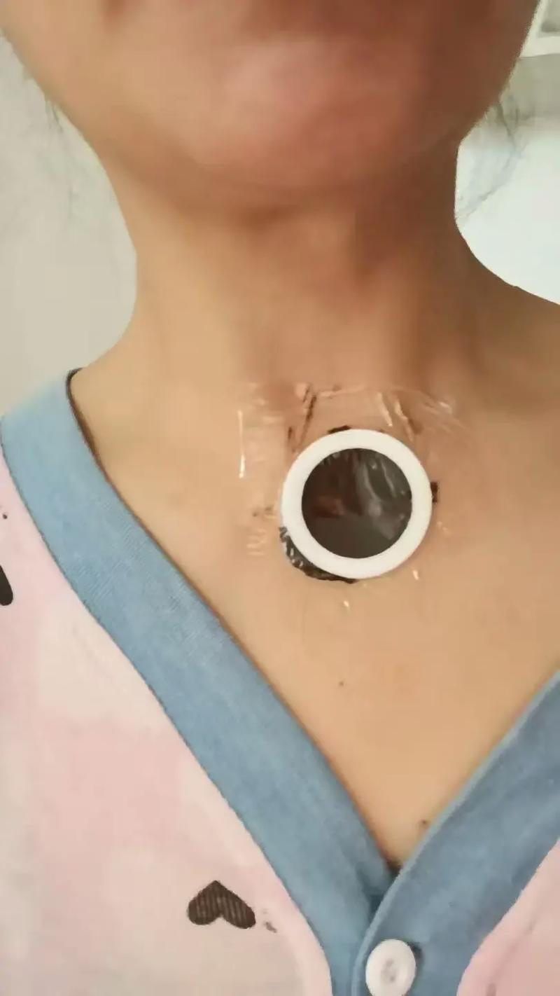 嗓子疼可以贴风湿膏吗