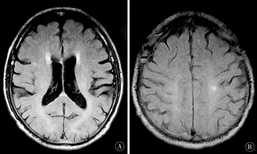 腔隙性脑梗mri表现