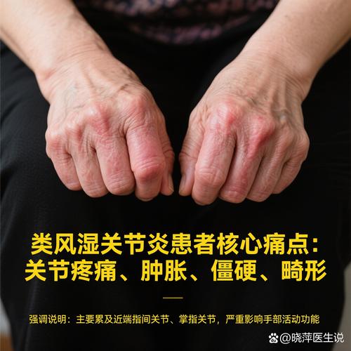 那家医院治疗类风湿病