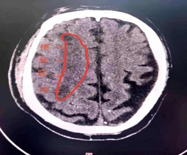 脑部ct能检查出脑梗