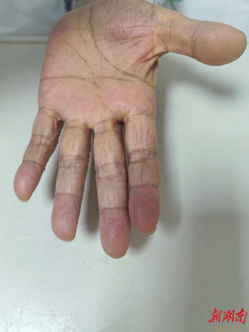 脑梗左手有知觉不能动