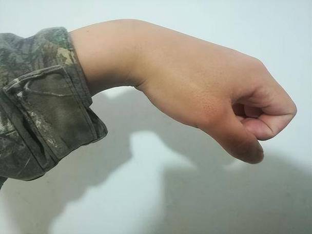 脑梗左手有知觉不能动