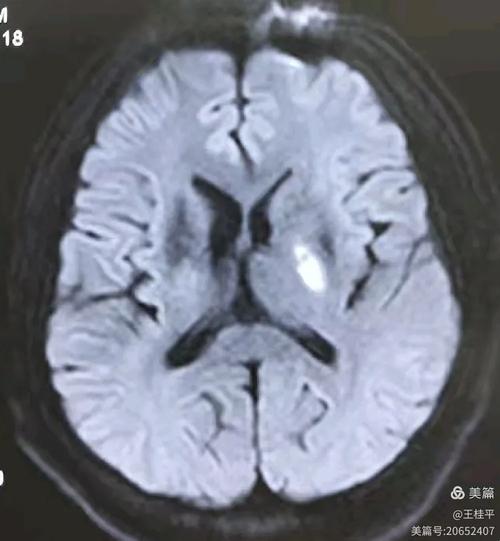 陈旧性脑梗mri特点