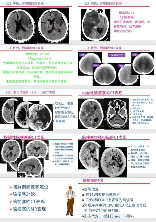 脑梗与脑肿瘤CT区别