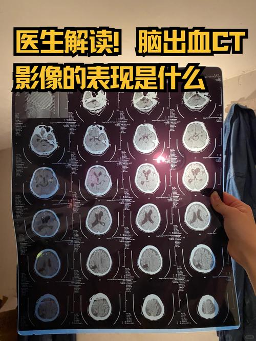 脑梗与脑肿瘤CT区别