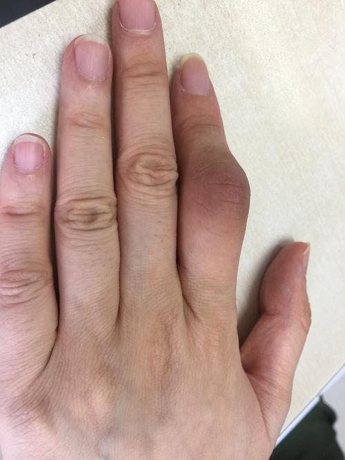 风湿病手痛是什么症状