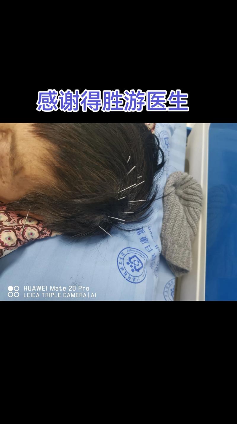 脑梗疏通血管扎什么针