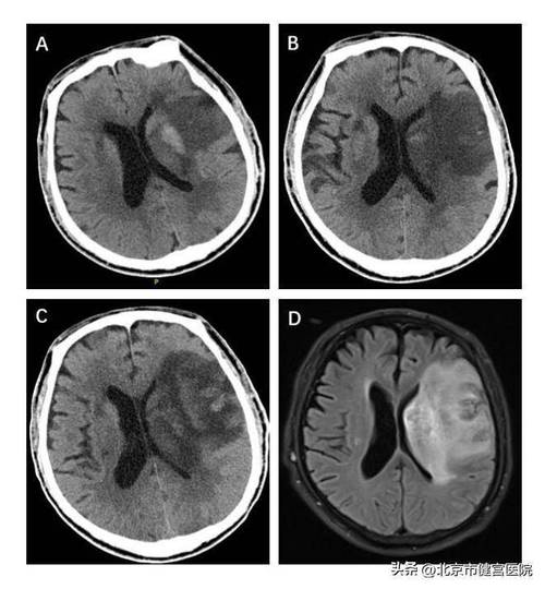 脑梗24小时ct变化