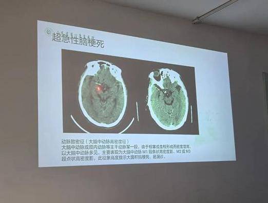 脑梗24小时ct变化