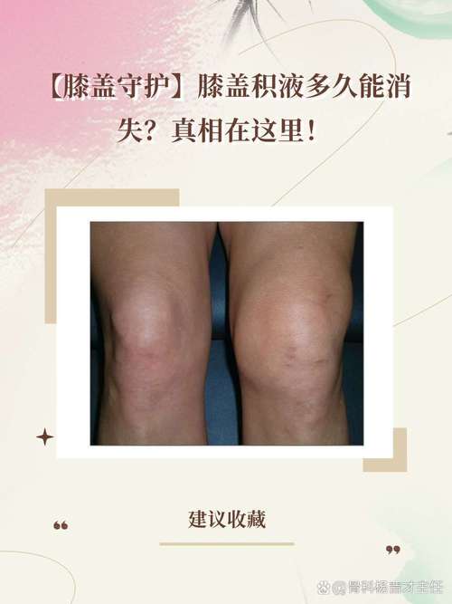 类风湿关节炎膝盖积水