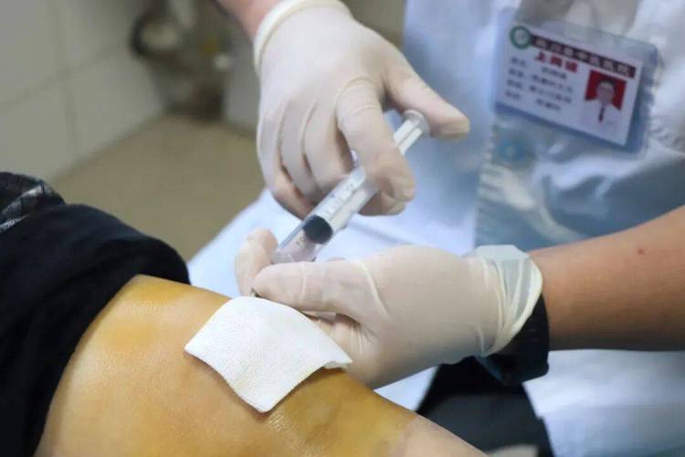 臭氧治疗类风湿关节炎