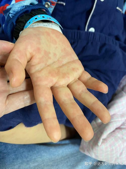 生完宝宝能得类风湿吗