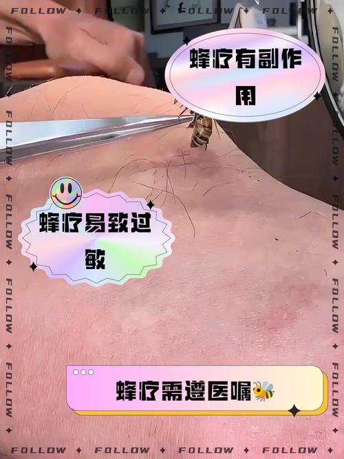 怎样用马蜂窝治疗风湿