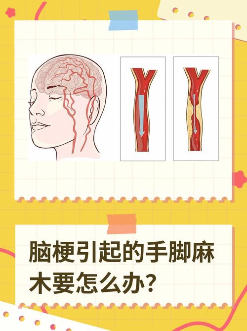 脑梗为什么会肢体麻木