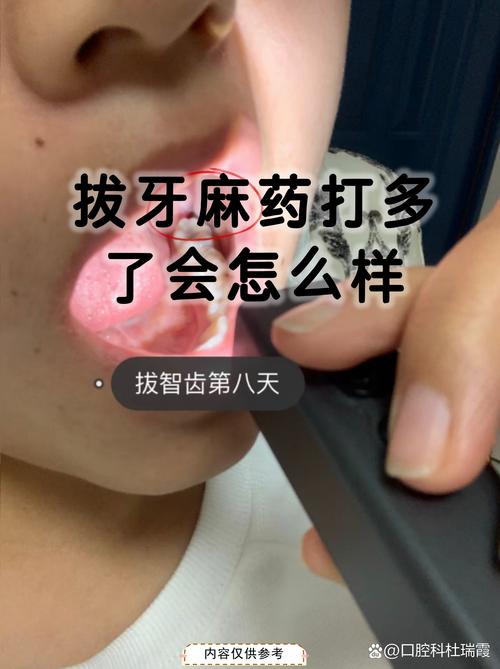 脑梗可以打麻药拔牙吗