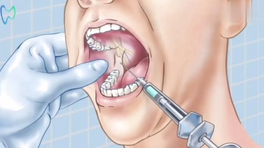 脑梗可以打麻药拔牙吗