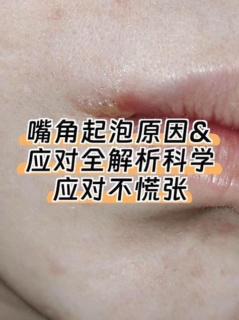 嘴唇周围起泡 穴位