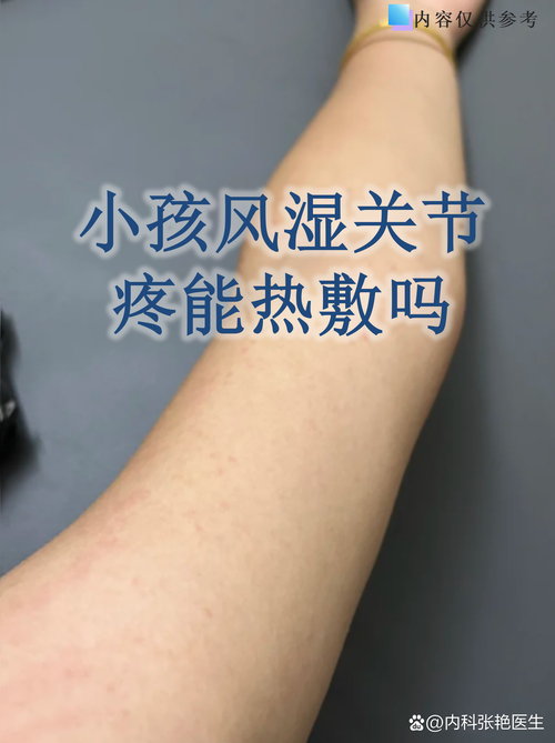 儿童风湿热的治疗方法