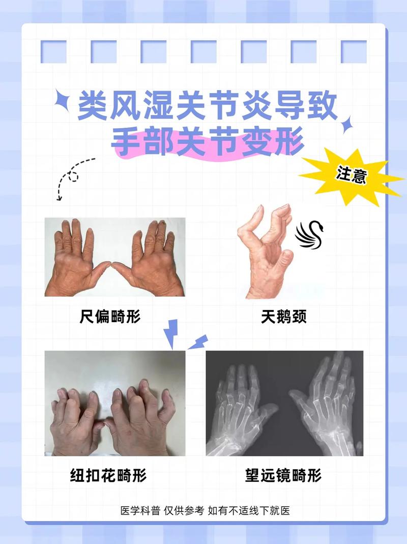 类风湿变形还能效正吗