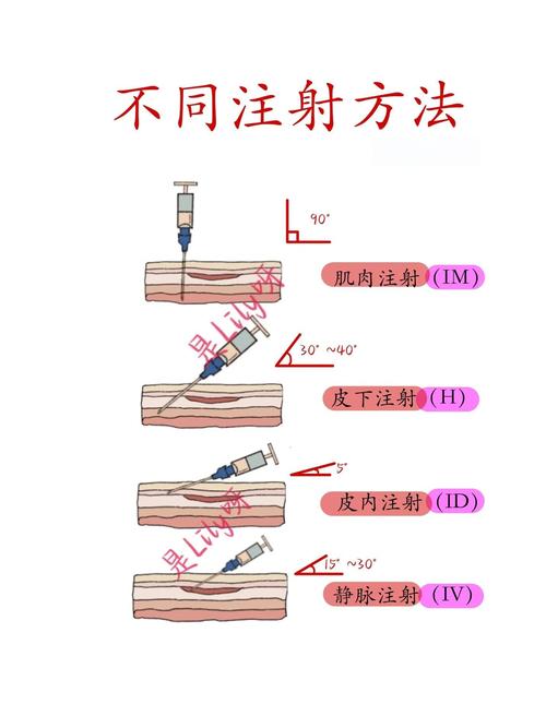 肌张力增高穴位注射