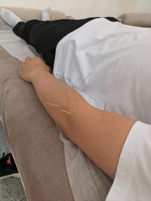 风湿关节炎针灸管用吗