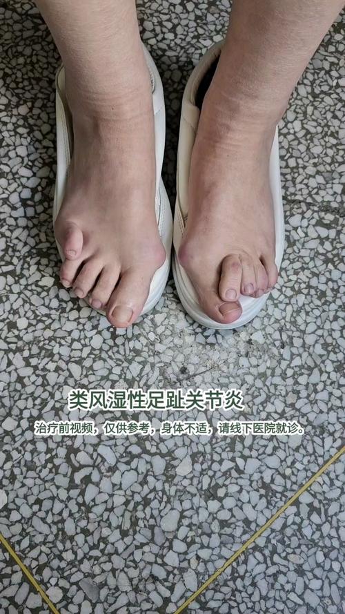 脚得风湿的症状有哪些